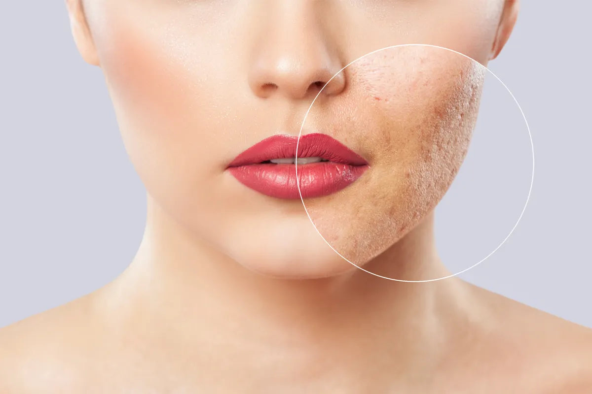 Combattere l’acne: consigli e prodotti per curare la pelle