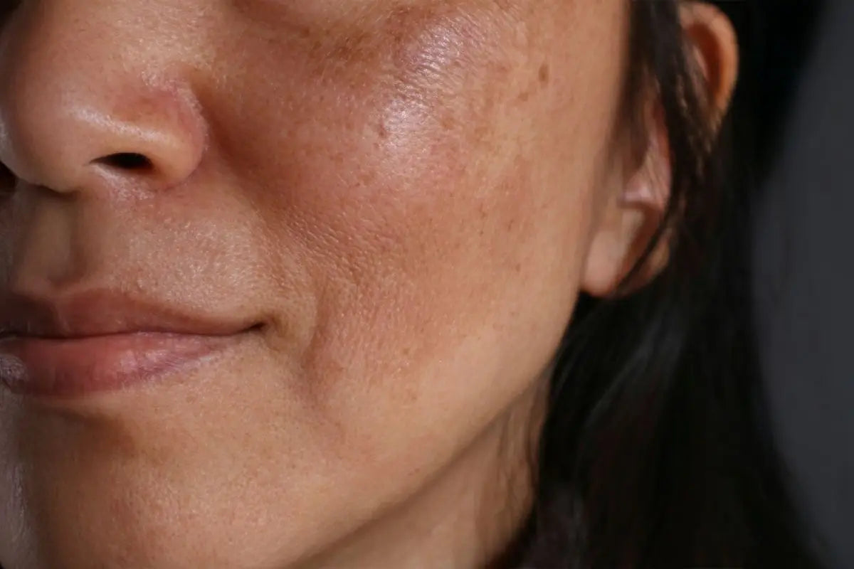 Melasma: cause, sintomi e trattamenti efficaci