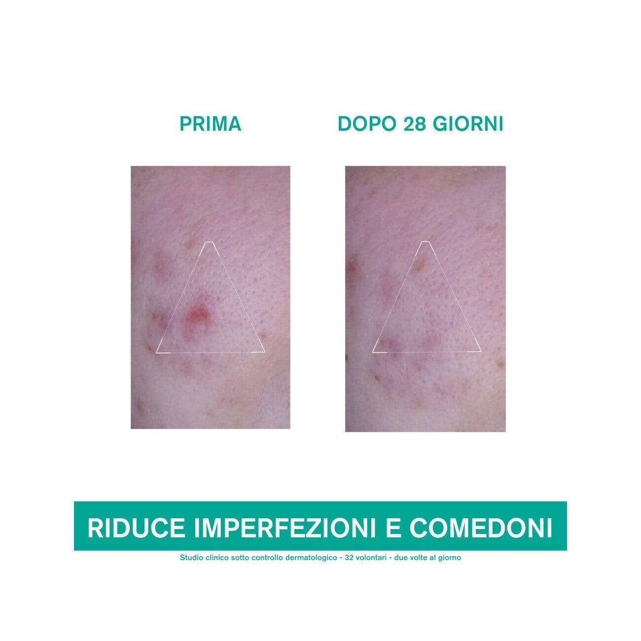 Uriage Hyseac 3 Regul+ Trattamento Globale Anti-imperfezioni 40ml-4